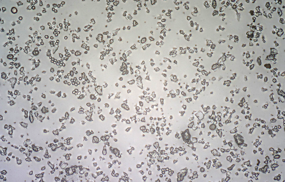 Auszug einer Probe mit extrem viel Aspergillus/Penicillium-Belastung der Raumluft und sehr vielen Estrich- bzw. Gipsstaubpartikeln.